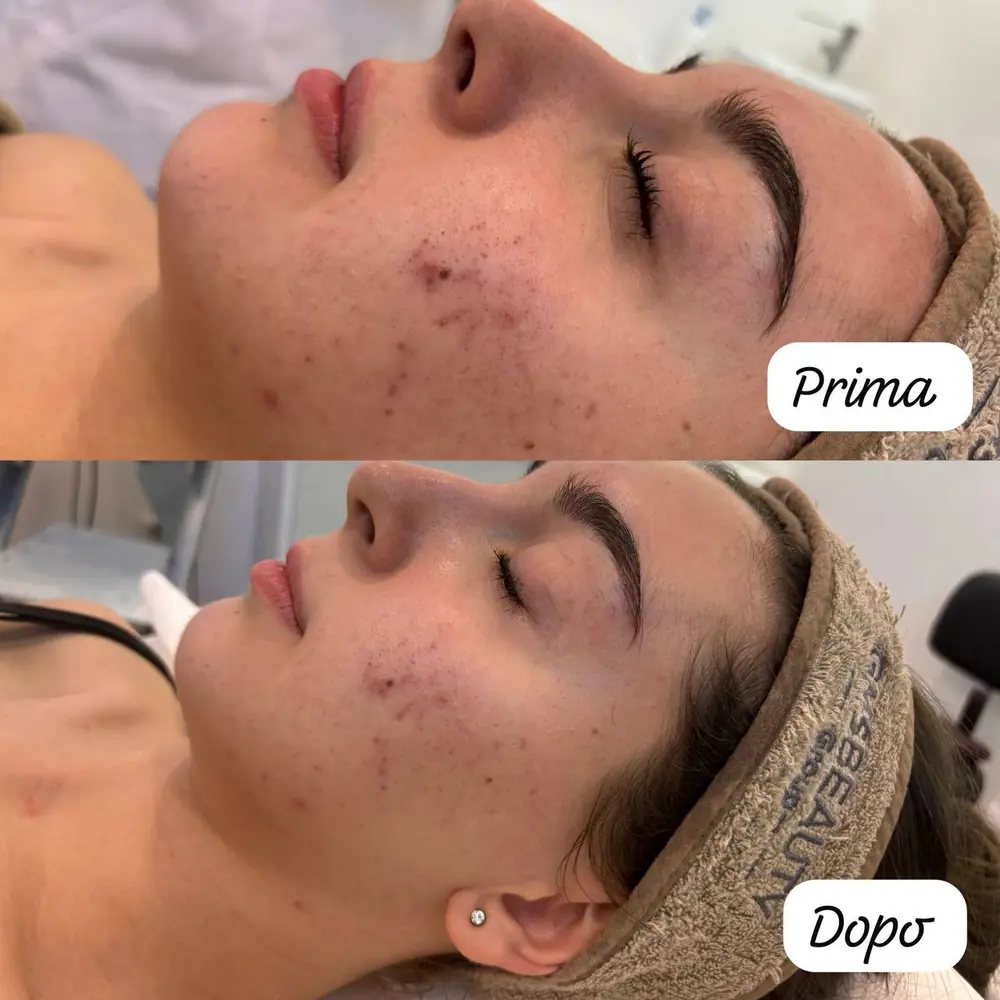 Prima e Dopo Trattamento